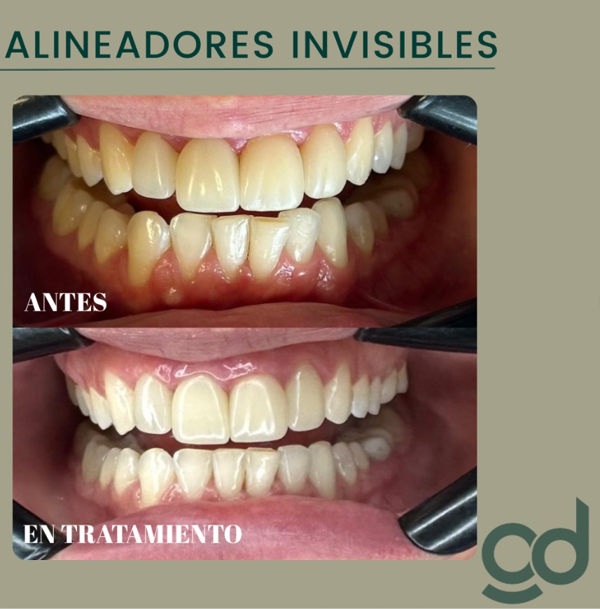 Tratamiento de Alineadores Invisibles