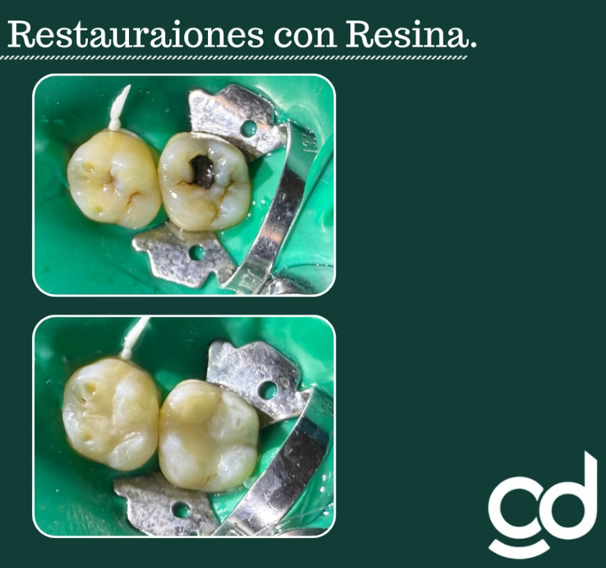 Fotografía clínica de aislamiento y restauración con resina